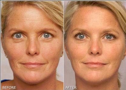 Tretinoin Gel 0.05%