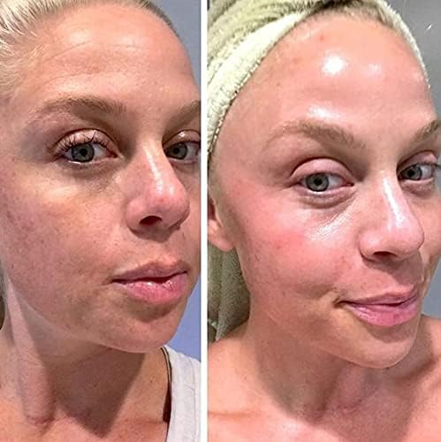 Tretinoin Gel 0.05%
