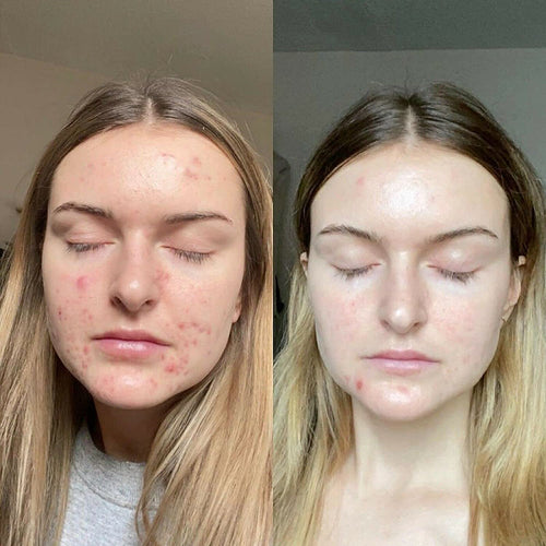 Tretinoin Gel 0.05%